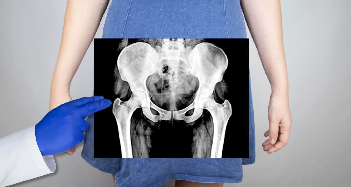 Can You Use A Cross Trainer With A Prolapse